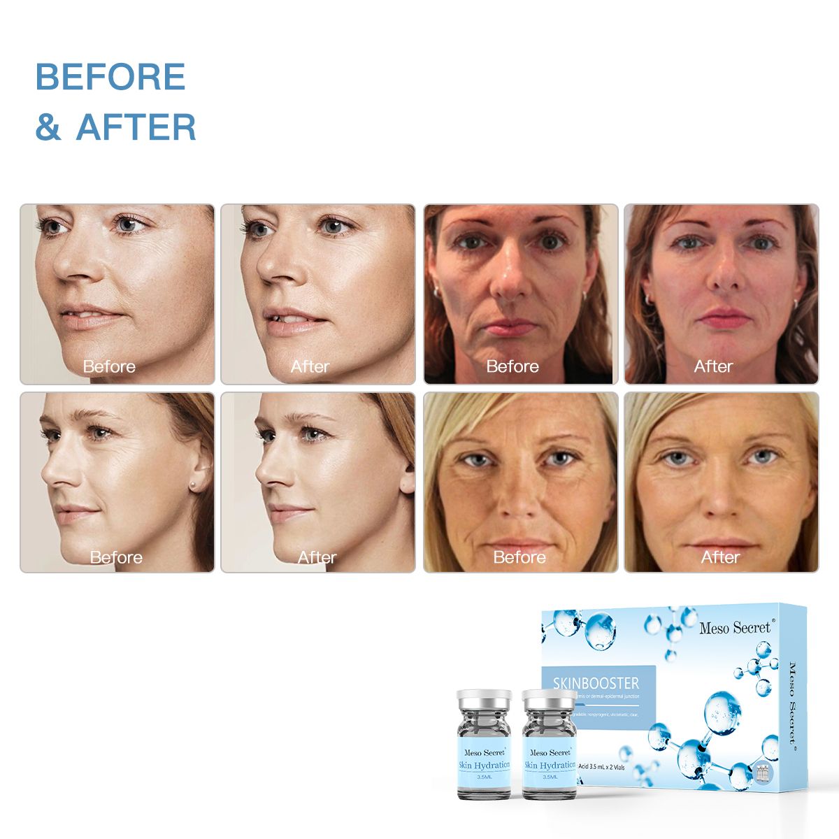 meso secret lip filler injections skinbooster hyaluronic acid