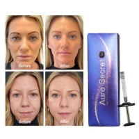 new arrival crosslinking technology upgrade anti wrinkle anti aging hyaluronic acid dermal filler