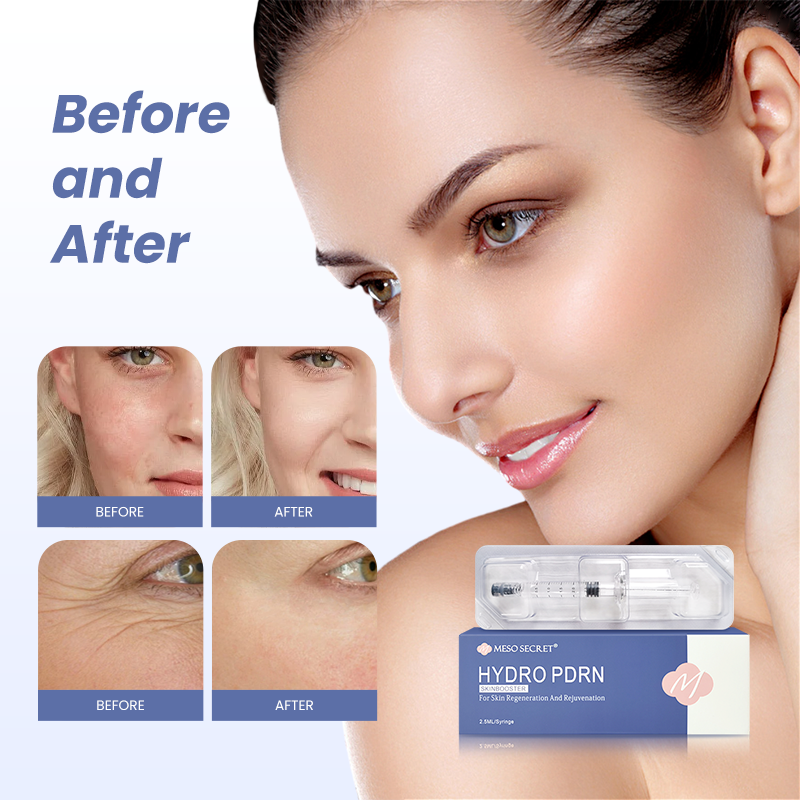 Improved acne scarring skin tone meso secret hydro pdrn skinbooster